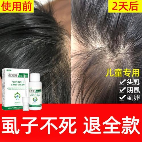 冬天能把头上的虱子冻死吗