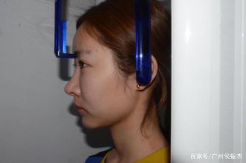 天生嘴翘的特征