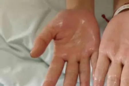 高考时怎样防止手出汗