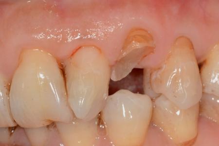 成年人的乳牙残根怎么处理