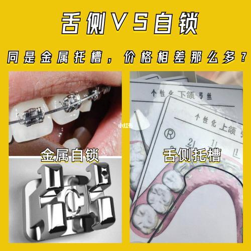 金属自锁托槽容易掉吗