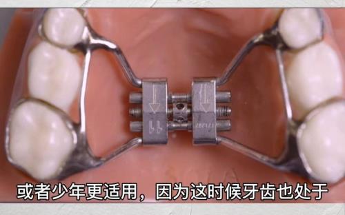 扩弓器用什么粘接最好