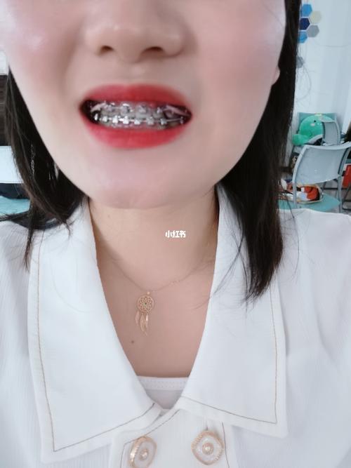 托槽皮筋要带多久
