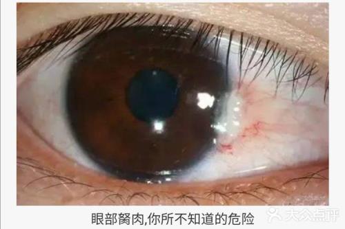 胬肉是什么