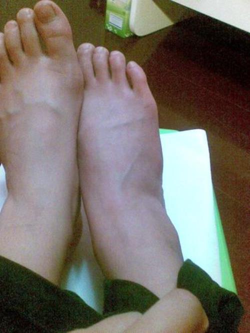 脚踝扭伤三月走路还会疼