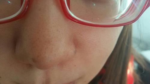 怎样去除黑头和缩小毛孔