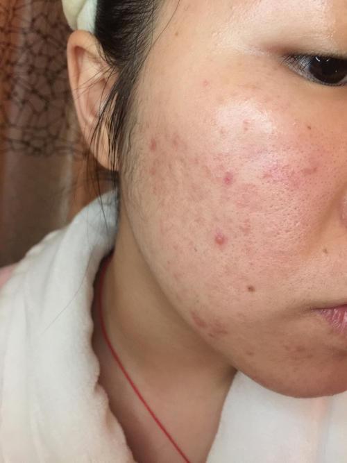 油痘肌是什么意思