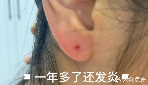 怎么判断耳洞长好了呢
