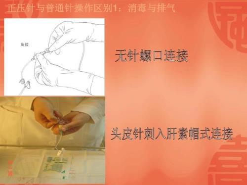 正压留置针和普通留置针的区别