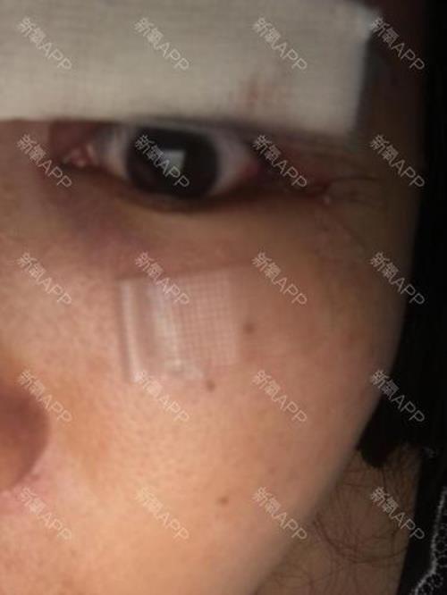 倒睫毛手术费用一般是多少