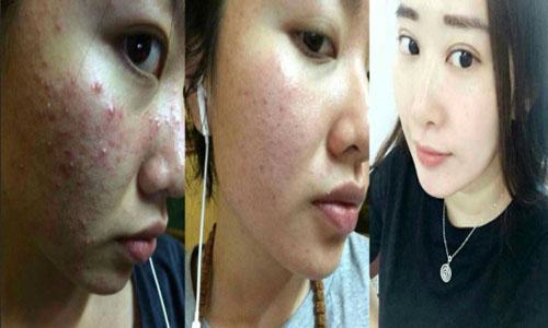 去痘印最有效的方法