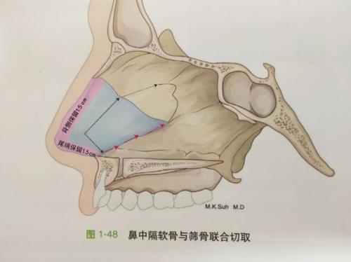 鼻中隔怎么形成的