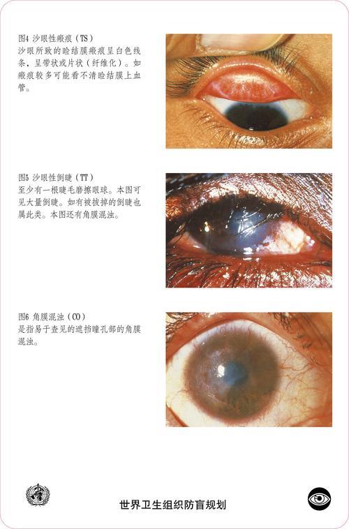 怎样治乌龟的沙眼