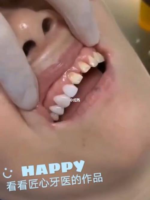 为什么牙医会往牙缝里塞一个圈