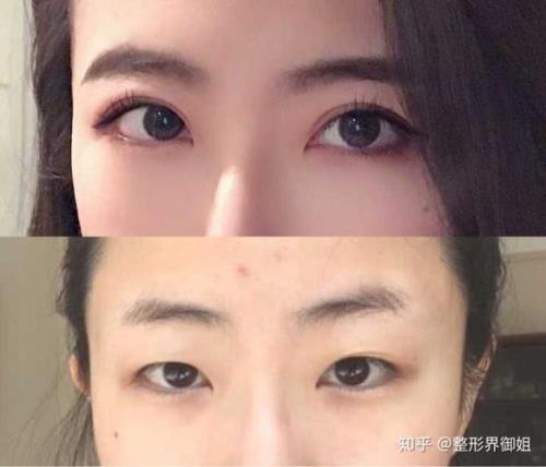 埋线双眼皮提肌和没提肌的区别