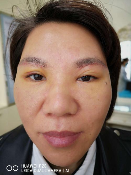 提眉术多久做一次合适