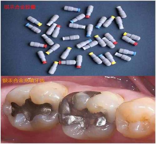 补牙银汞材料牢固吗