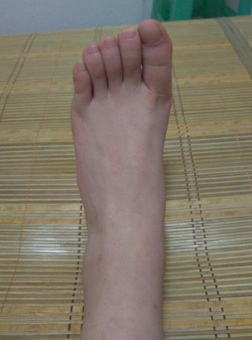 爸妈都是罗马脚宝宝一定是吗
