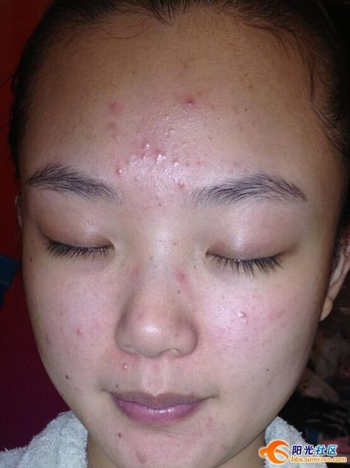 女生说长痘痘怎么回复