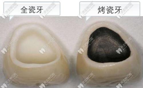 烤瓷材料的烧结温度