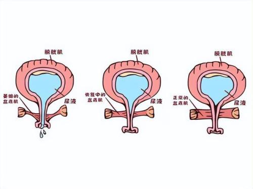 腹压是什么意思