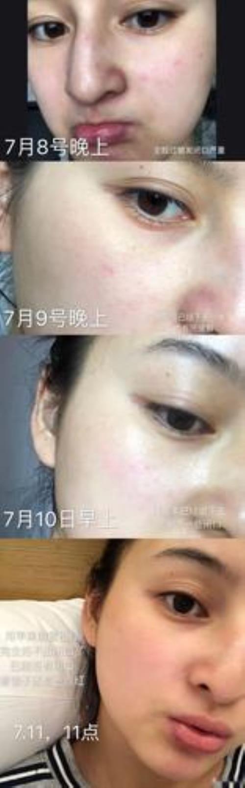 刷酸能用大水滴吗