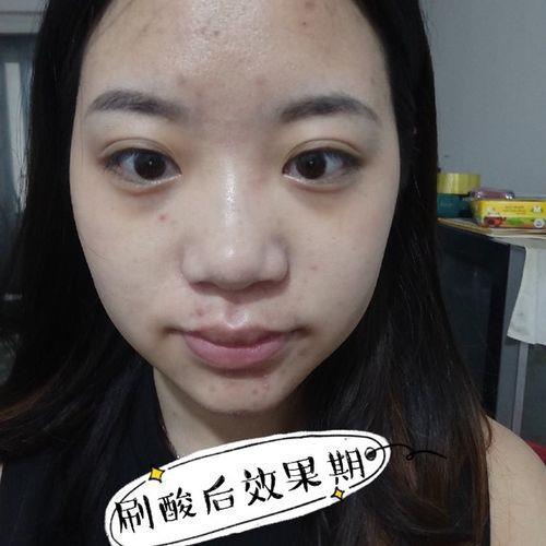 刷酸是什么意思