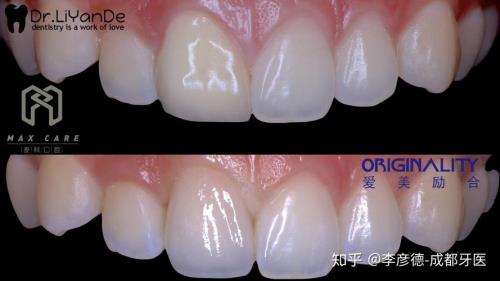 全瓷牙颜色有点黄可以返工吗
