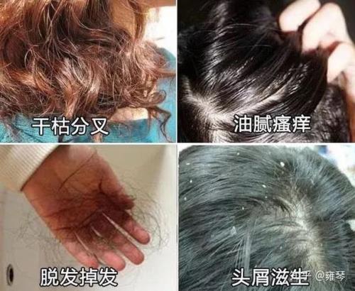 正确洗头方法去屑