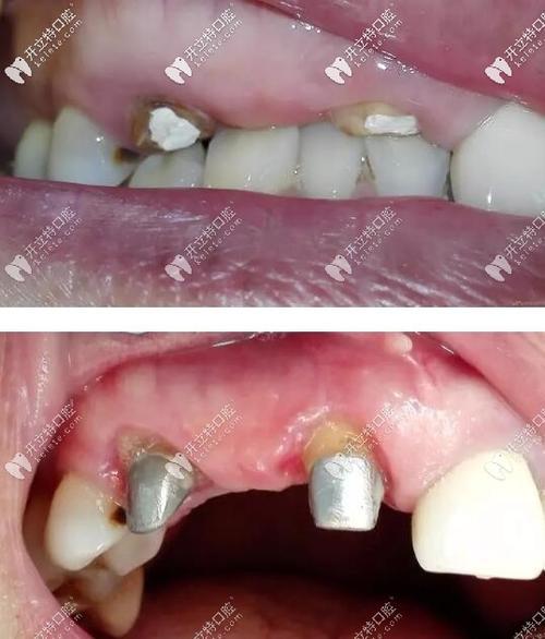 镶活动牙选择最舒适的是哪种