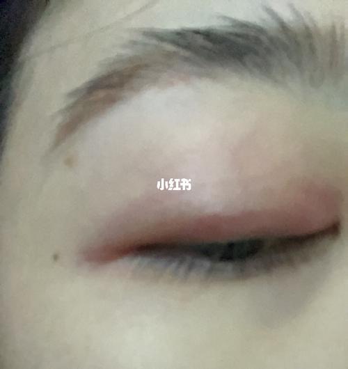 霰肿粒怎么念