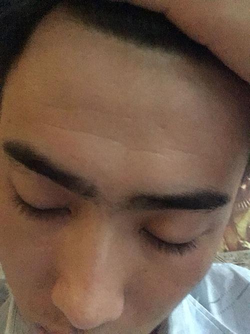 少年抬头纹是怎么回事