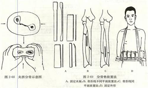 身体里有钢板可以坐飞机吗