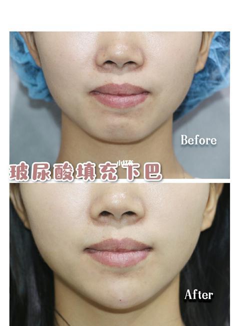 玻尿酸填充下巴哪个牌子比较好