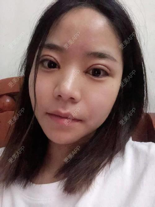 重庆哪里做埋线双眼皮做的好