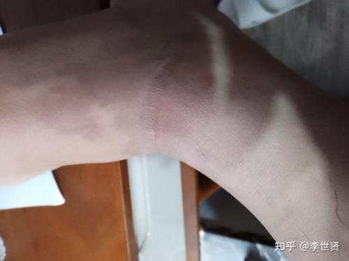 征兵伤疤的标准是什么